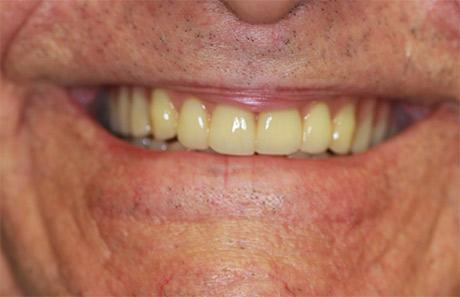 Dentures Image