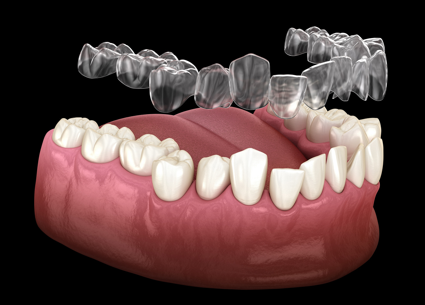 Invisalign clear aligners for straighter smiles