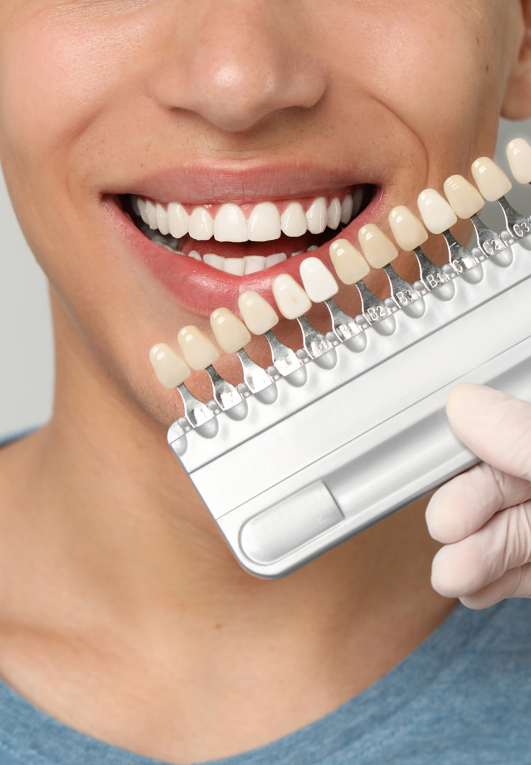 Veneers Banner Image